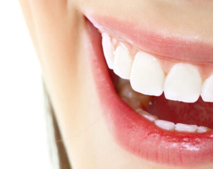 Easily Get the Smile you Want With Veneers or Dental Bonding