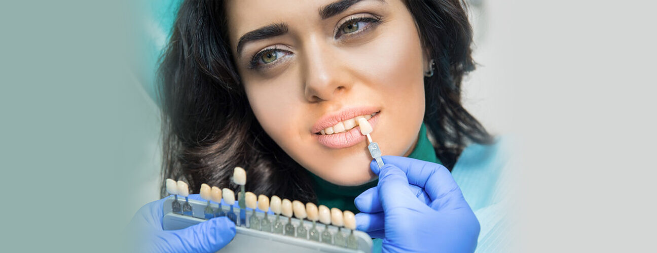 Dental Veneers