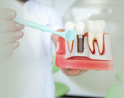 Dental-Implant_1